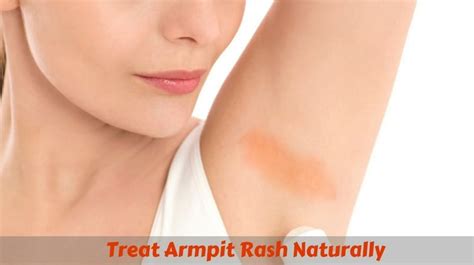 10 Best Remedies To Treat Armpit Rash Naturally