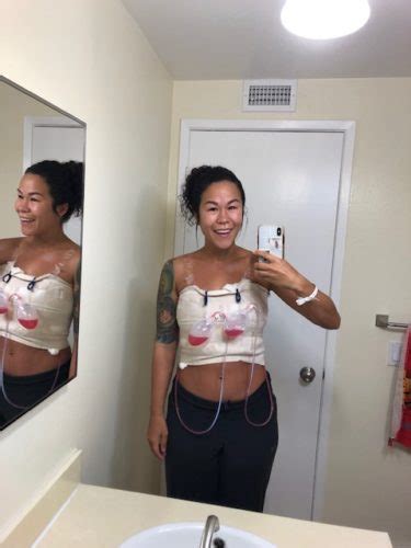why i removed my breast implants one week post explant breast