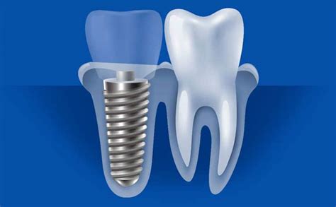 dental implants titanium preferred choice memphis