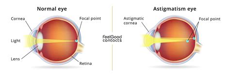 ultimate guide  astigmatism feel good contacts uk