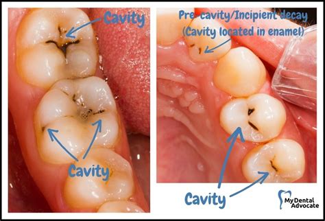 cavity    pictures mda