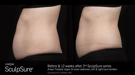 Body Contouring Before And After Clc Beauty Rx