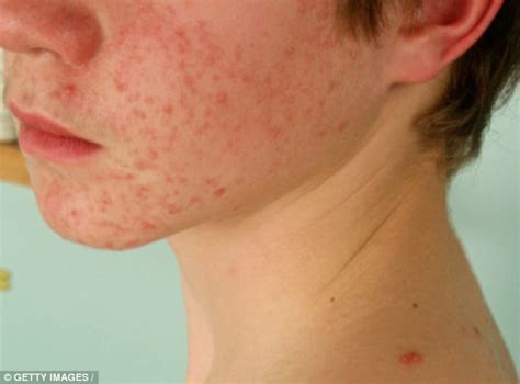 Overweight Teenage Girl With Acne
