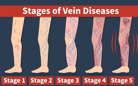 venous disease millions suffer  treatments   life changing vein specialists