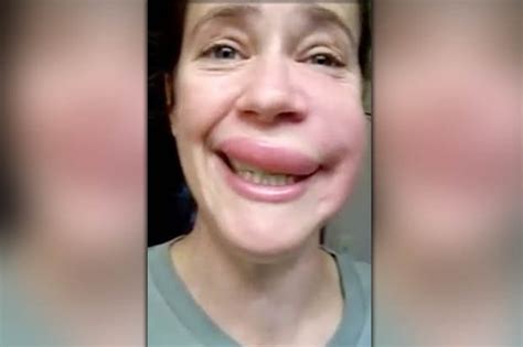 woman has hilarious allergic reaction to wasp sting on her cheek