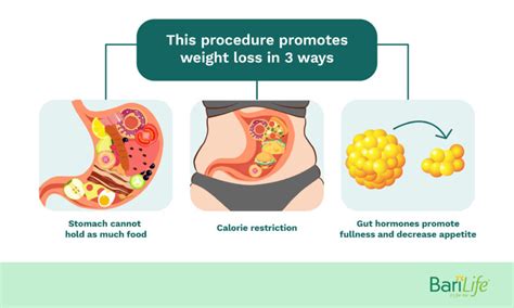 Pros And Cons Of Gastric Bypass Surgery Everything You