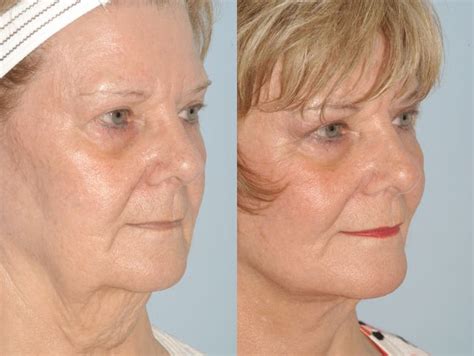 Face Lifts Before And After Photos Bessieroegner 99