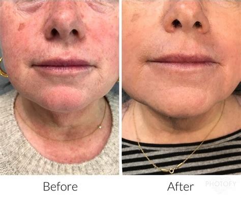 microneedling manchester nh pelle medical spa