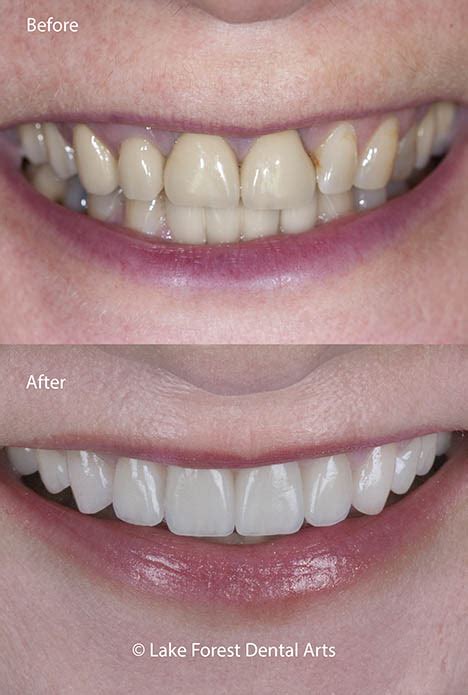 front tooth crowns     disappear