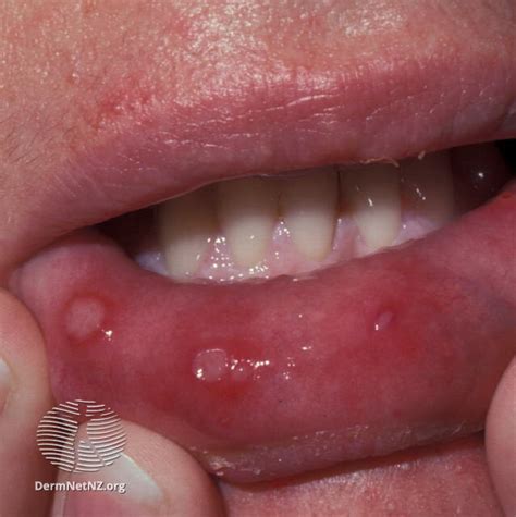 hand foot and mouth disease — charlotte dermatology p a