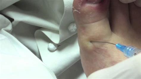 ingrown toenail removal podiatrist youtube