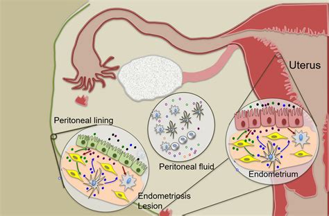 endometriosis  adenomyosis explained  mit center