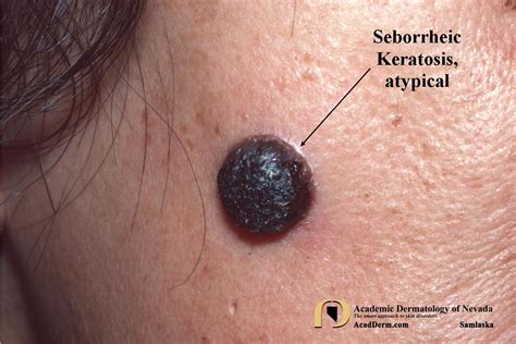 seborrheic keratosis atypical forms academic dermatology  nevada