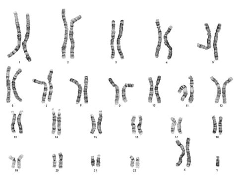 klinefelter syndrome uvm genetics and genomics wiki fandom powered by wikia