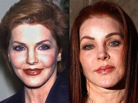 celebrities before and after a plastic surgery 21 pics