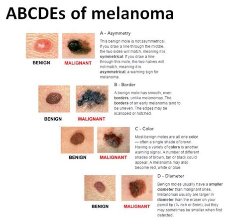 Stages Melanoma Skin Cancer Moles