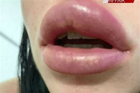 woman almost went blind after lip fillers burst and she swallowed