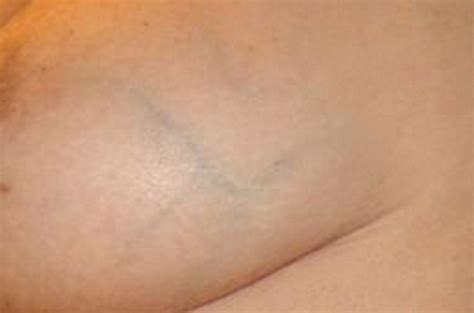 prominent blue veins in breast mega porn pics
