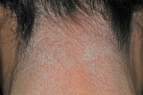 neurodermitis  liquen simple cronico del cuero cabelludo dermatopharm