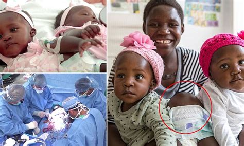 conjoined twin girls from uganda separated in ohio surgery daily mail online