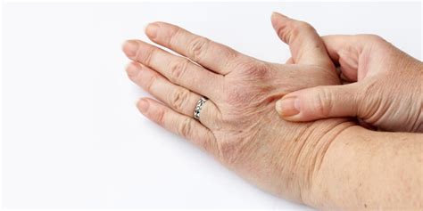 einnahmen experte beschwerde artrose handen ringen zerstreuen ekstase konjugieren
