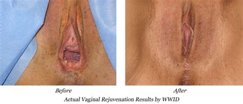 designer vagina before and after cumception
