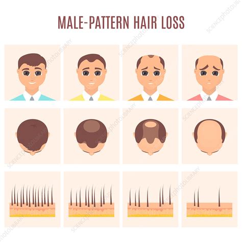 male pattern hair loss illustration stock image  science photo library