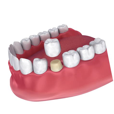 common questions  dental crowns marx family dental