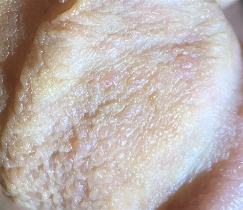 Are These Hpv Warts Penis Disorders Forums Patient