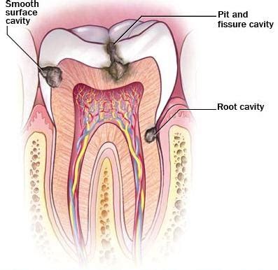 cavities  dental care info