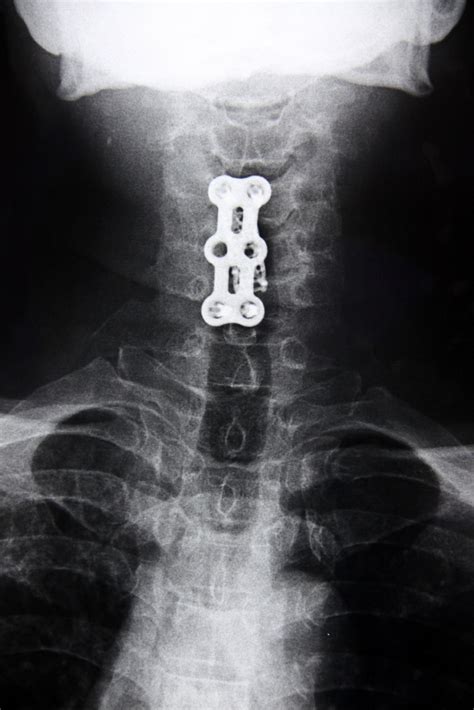 Spinal Fusion Spine Back And Neck Pain Information Blog Spine