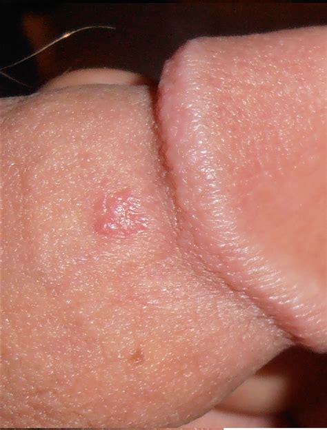 friction blisters on penis transexual you porn