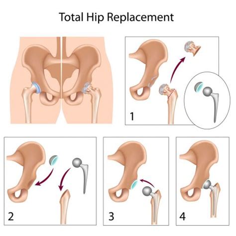 Total Hip Replacement Surgery Osmi Fort Worth