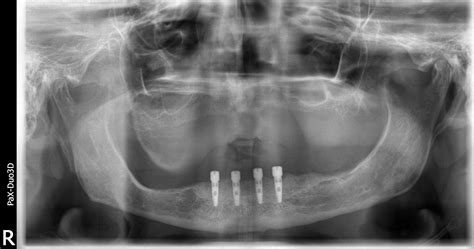 bone reduction leveling  dental implants  avoid  bone graft