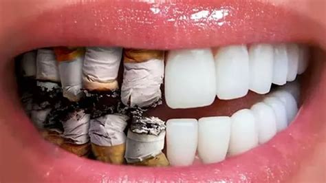 how smoking causes gum disease the effects of smoking on teeth