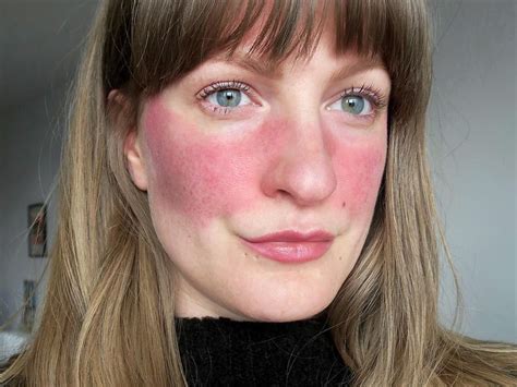 11 People Describe What It S Really Like To Have Rosacea