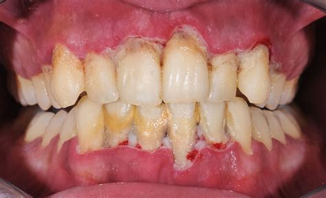 common signs  gum disease absolute dental