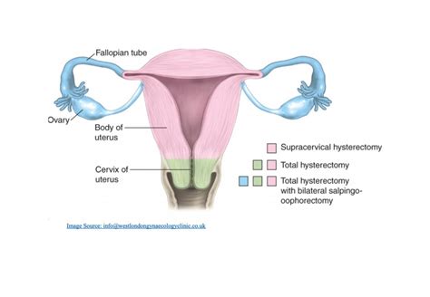 uterine fibroid embolisation and other fibroid treatments sydney