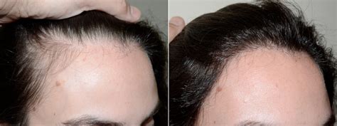 Hair Transplants For Women Photos Miami Fl Patient71499