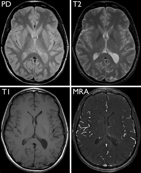 exploring  brain   brain images   mri ucsf radiology