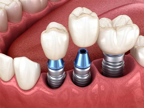 complete guide  dental implants dentevim dental clinic