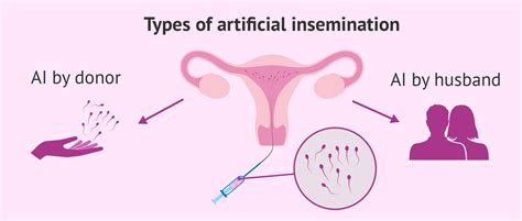 iui with donor sperm definition process and success rates