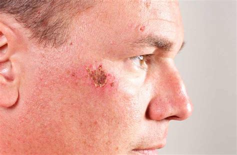scabs  face  fast treatment ways skincarederm