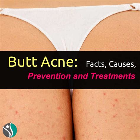 Butt Acne Facts Causes Prevention And Treatments