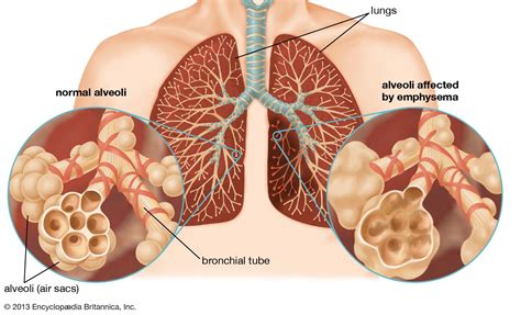 Chronic Obstructive Pulmonary Disease Copd Britannica
