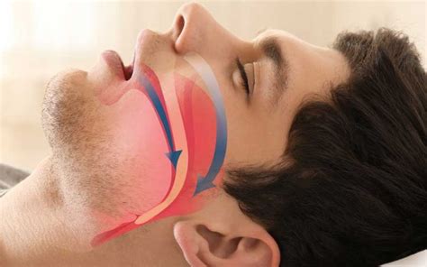 obstructive sleep apnea treatment sleep apnea portland oral surgery