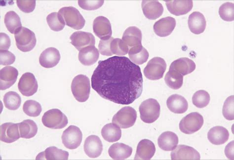 epistaxis ecchymoses   abnormal white blood cell count