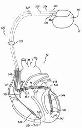 Patents Coronary Sinus Cardiac Lead sketch template
