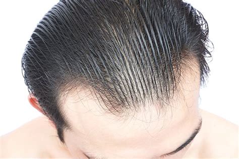 top  image normal hair part  thinning thptnganamsteduvn