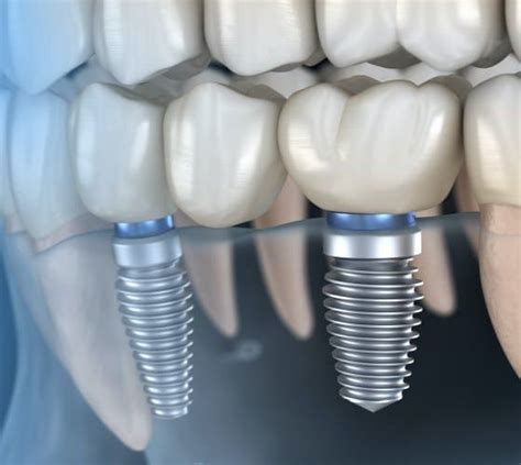 dental implants bloomingdale il pure dental spa